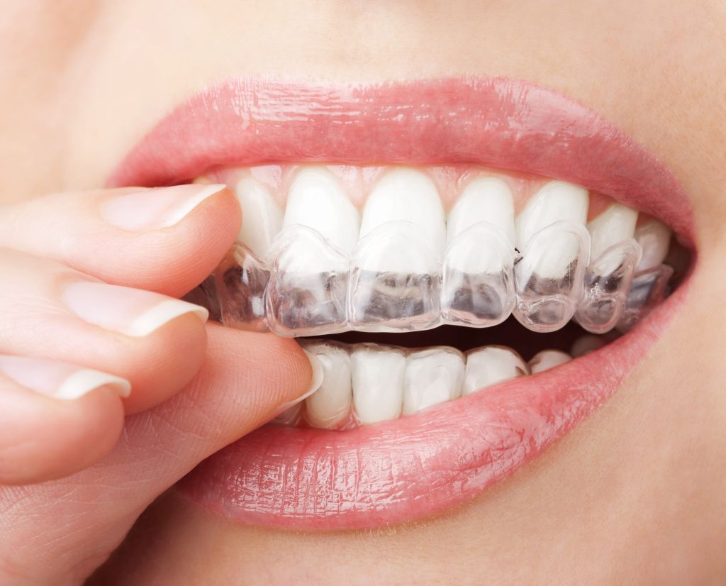 Invisalign-Touchup